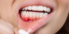 قد يكون مركب النبات هو السلاح السري ضد مرض اللثة