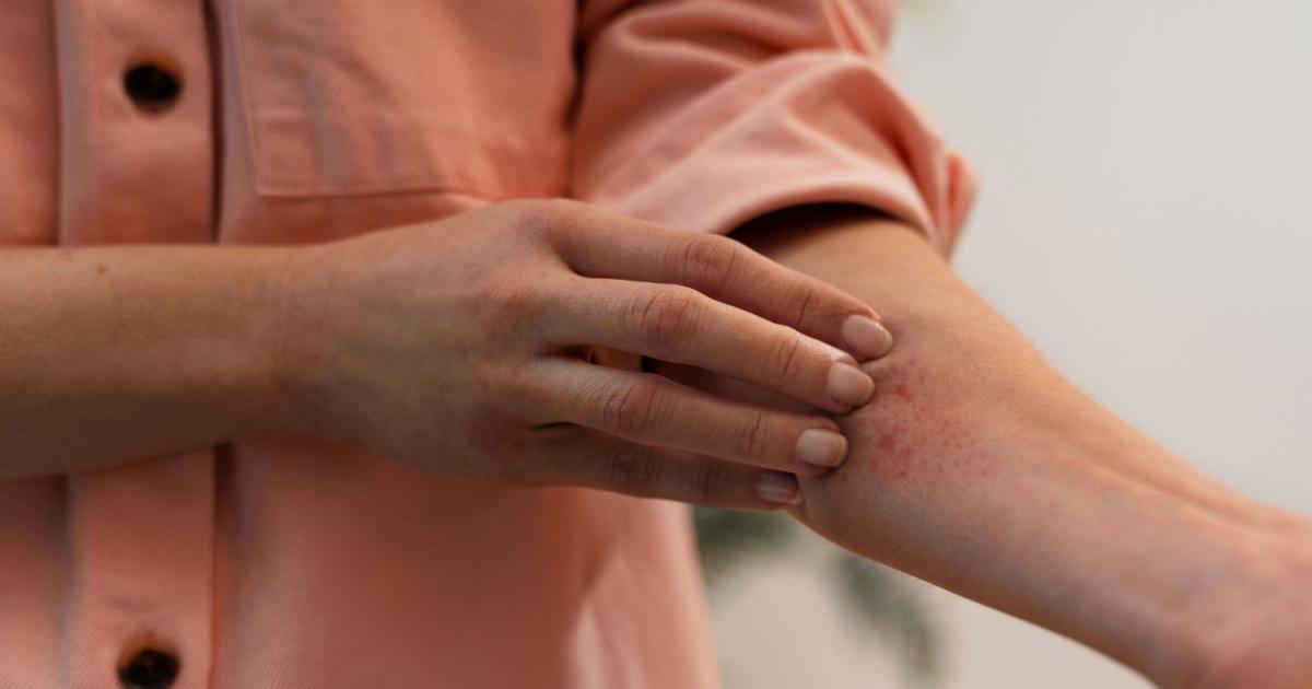 حساسية الجلد المفاجئة .. ما هي الأسباب المحتملة للطفح الجلدي ؟