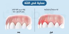 عملية قص اللثة: دواعيها ومخاطرها | صحتك