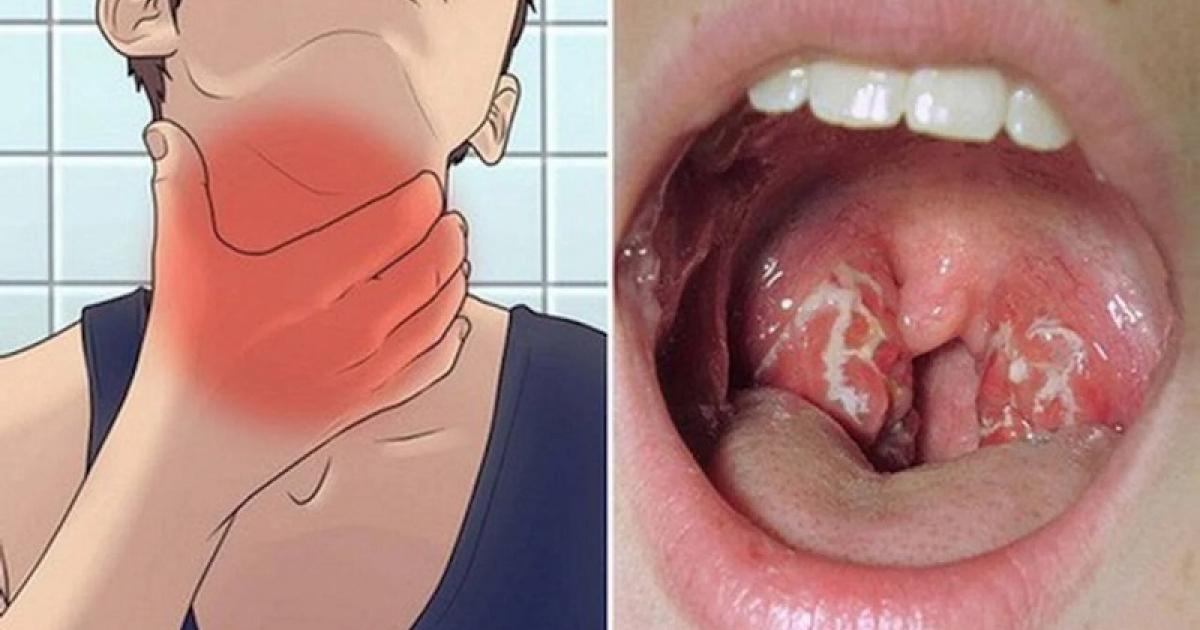 ما هو داء الدفتيريا أو الخناق وهل يوجد لقاحات للوقاية منه؟