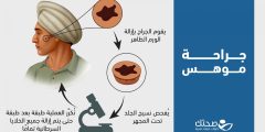 ما هي عملية جراحة موهس ومتى يتم هذا الإجراء؟