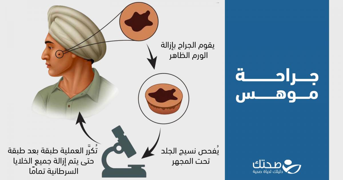ما هي عملية جراحة موهس ومتى يتم هذا الإجراء؟