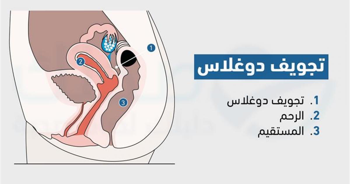 كتلة في تجويف دوغلاس .. حميدة أم خبيثة؟