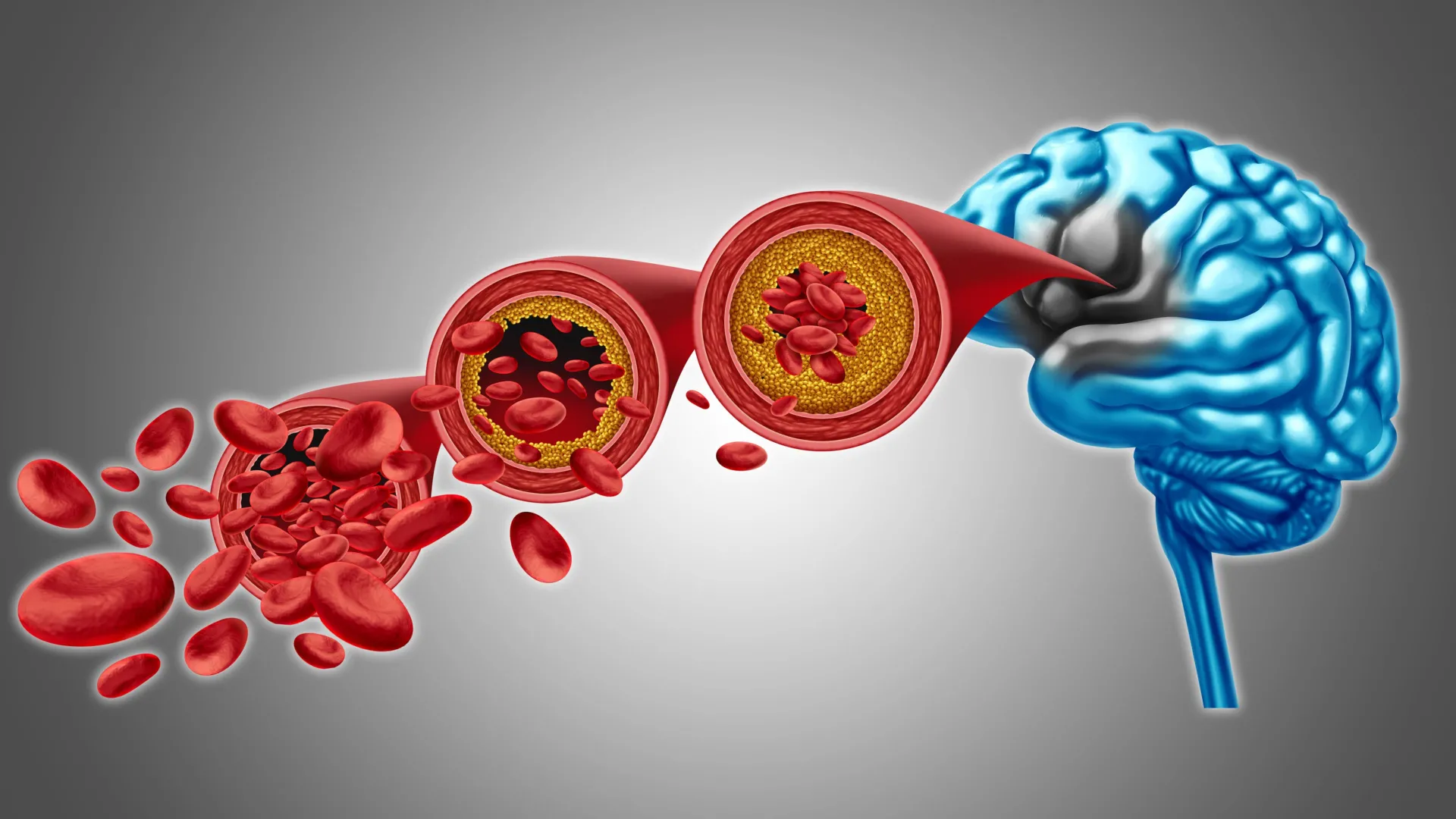 وجد العلماء طريقة لاستعادة تدفق الدم في الدماغ في حالة الخرف