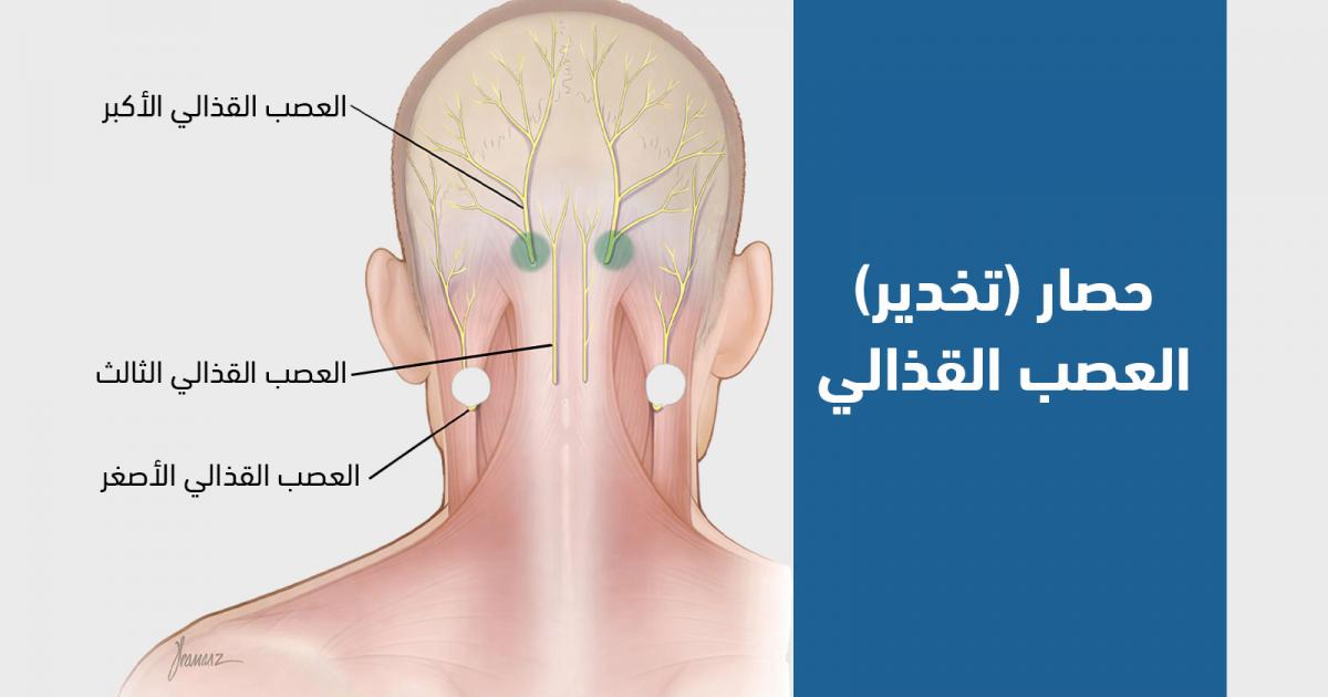 حصار الأعصاب القذالية: إجراء لعلاج العصب القذالي فكيف يتم؟