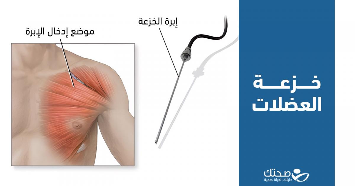 كيف تؤخذ خزعة العضلات وما الأمراض التي تشخصها؟