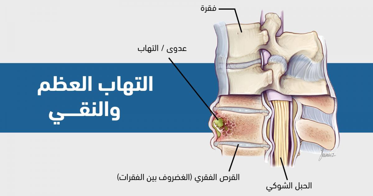 ما هي أعراض التهاب العظم والنقي وهل هو خطير؟