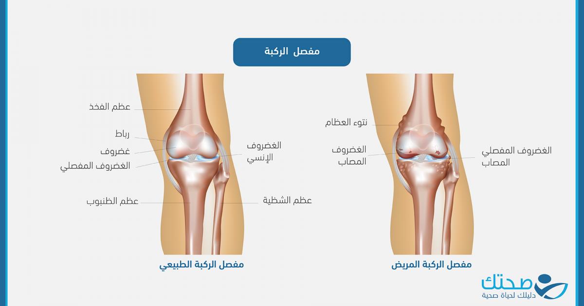 متلازمة الألم الرضفي الفخذي: ألم الركبة الصامت