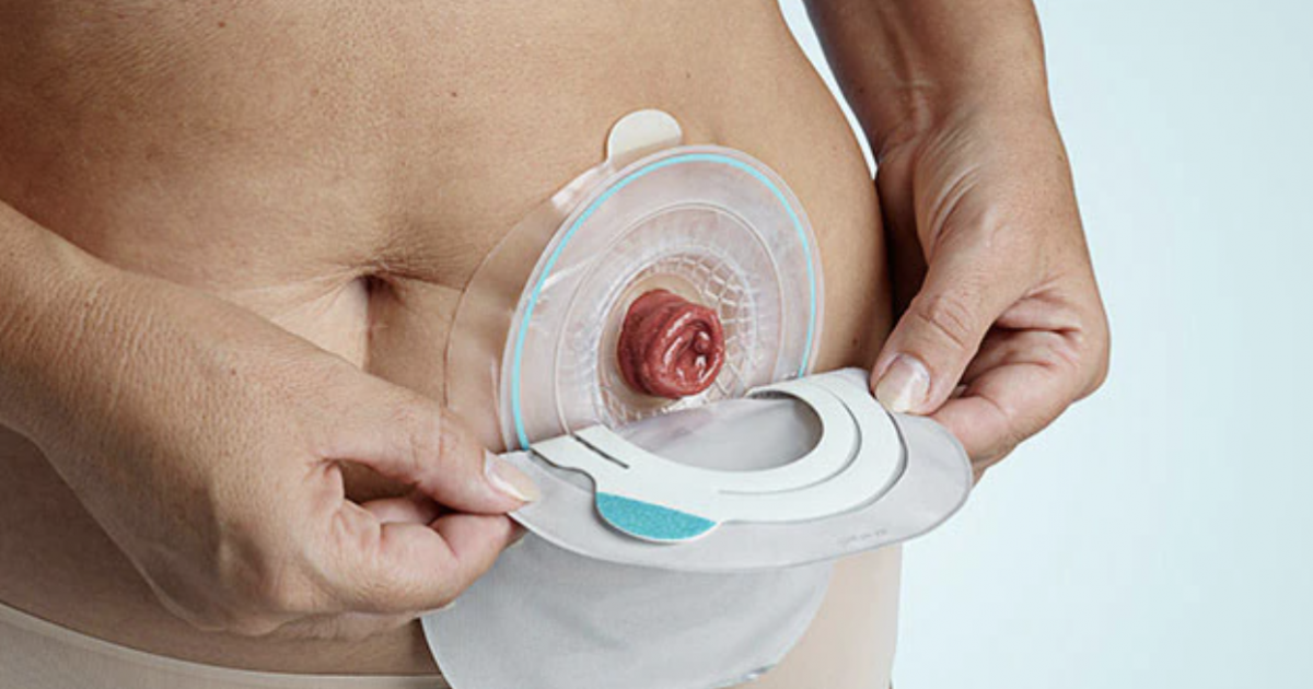 متى ولماذا قد يحتاج الشخص إلى كيس الفغر أو كيس ستوما؟