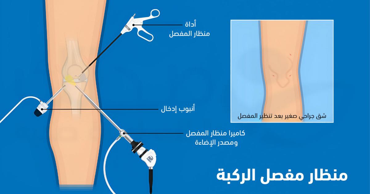 منظار مفصل الركبة: كيف يتم وما هي دواعي هذا الإجراء؟