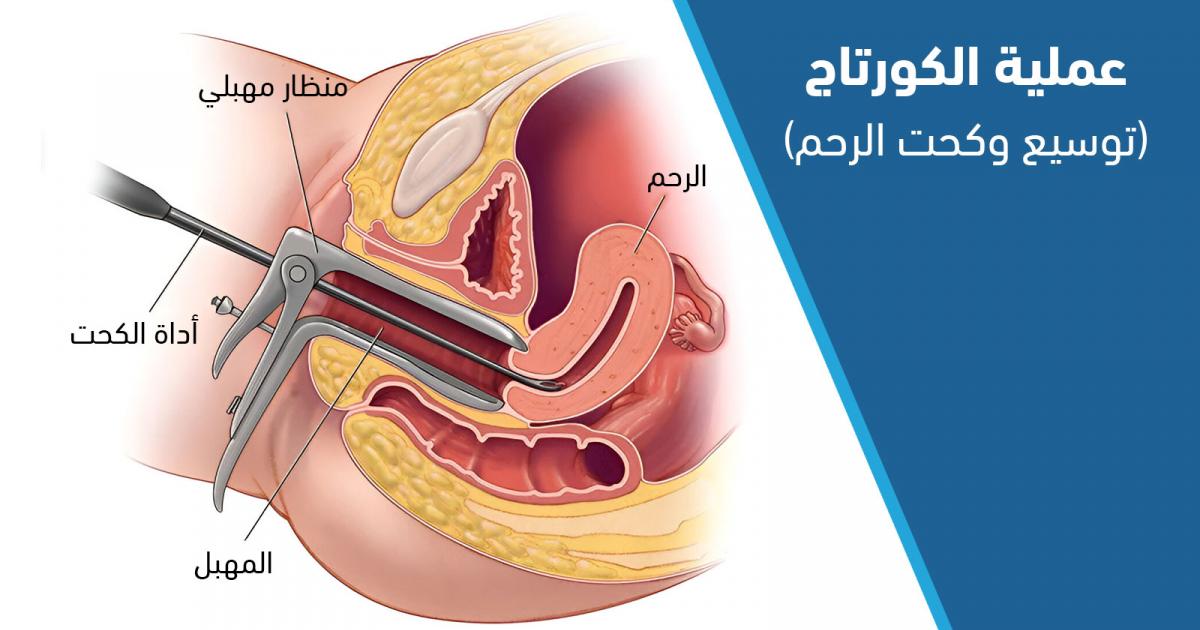 هل عملية الكورتاج آمنة، وكيف تتم، وما دواعي إجرائها؟