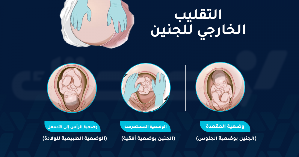 تغيير وضعية الجنين: كيف يتم الإجراء وما هي الدواعي؟