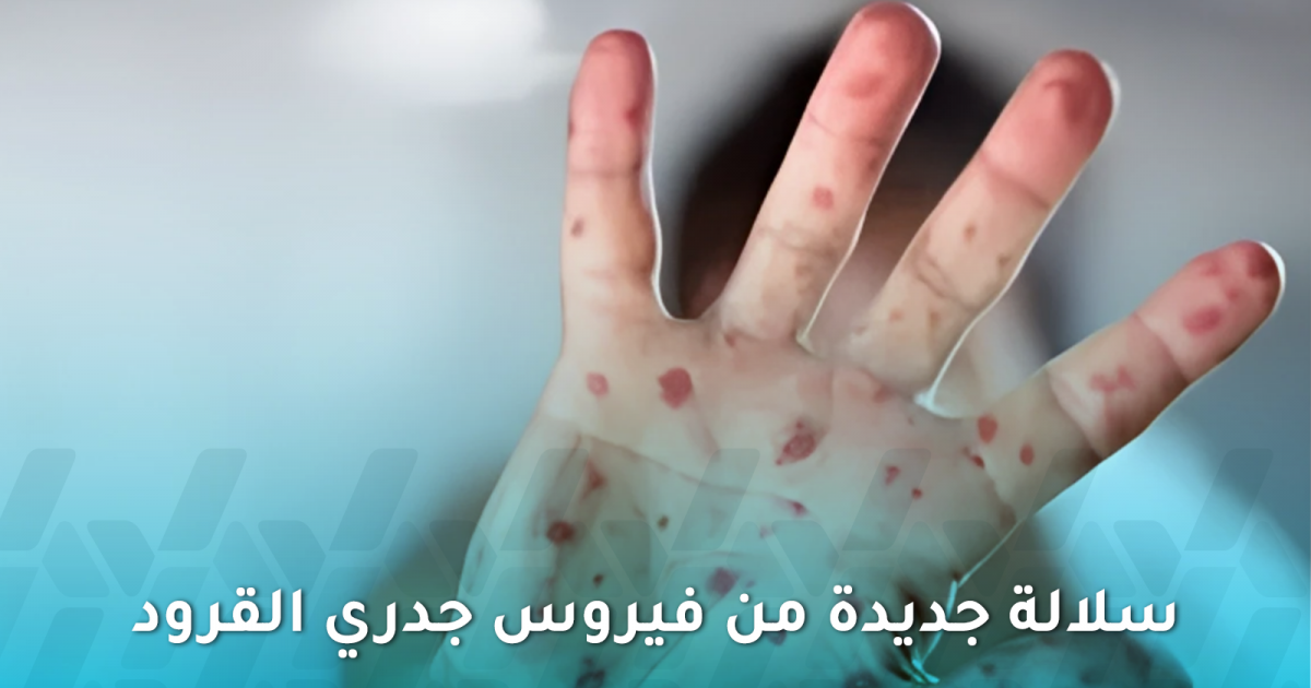 ظهور سلالة جديدة من فيروس جدري القرود في المملكة المتحدة والهند