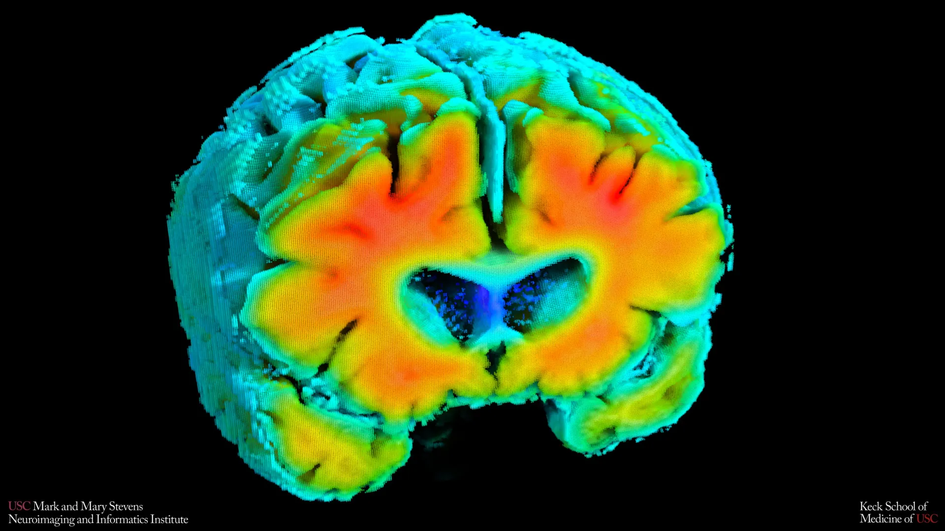 قد يبدأ مرض الزهايمر بانخفاض صامت في تدفق الدم في الدماغ