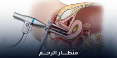 هل منظار الرحم مؤلم وما مدة هذا الإجراء؟