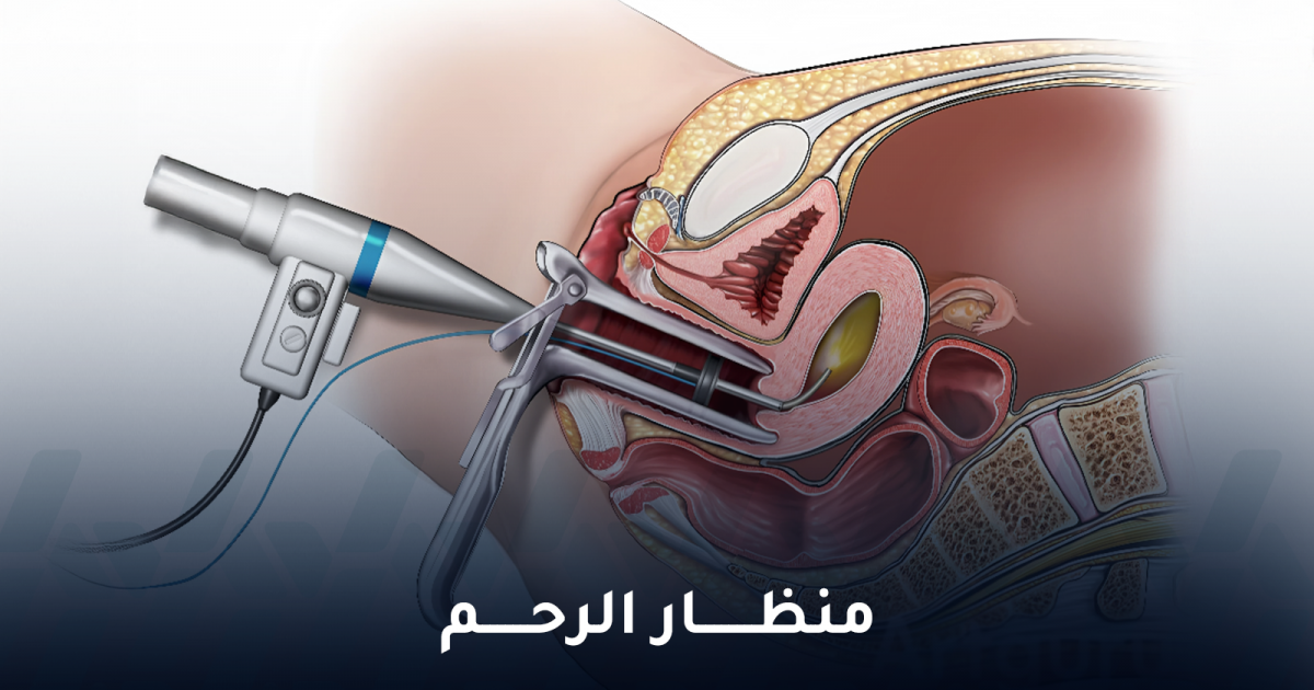 هل منظار الرحم مؤلم وما مدة هذا الإجراء؟