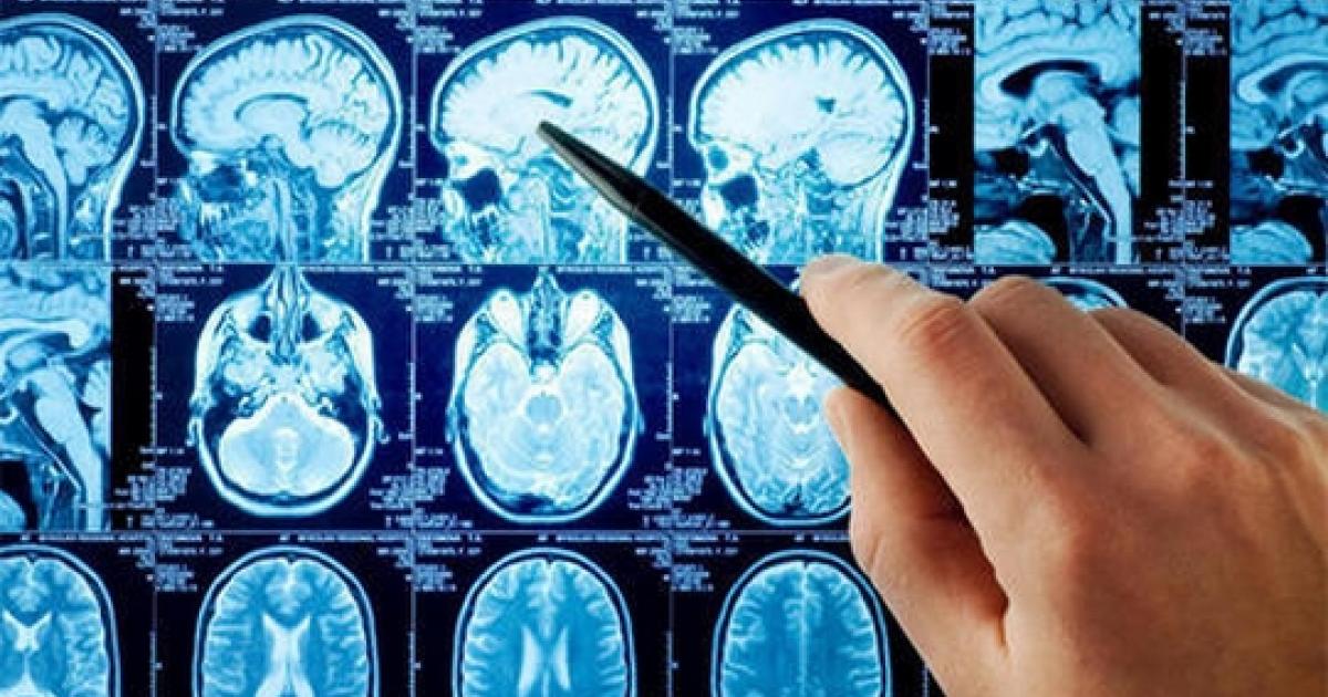 الشلل البصلي المتزايد: الأعراض والأسباب وطرق العلاج
