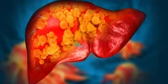 اكتشاف Mayo Clinic لطفرة جينية تسبب مرض الكبد الدهني
