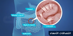 أسباب التصاقات الأمعاء: الأعراض وطرق العلاج