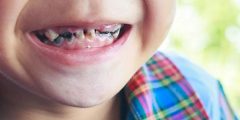ما هي أسباب تسوس الأسنان المبكر وهل من السهل علاجها؟
