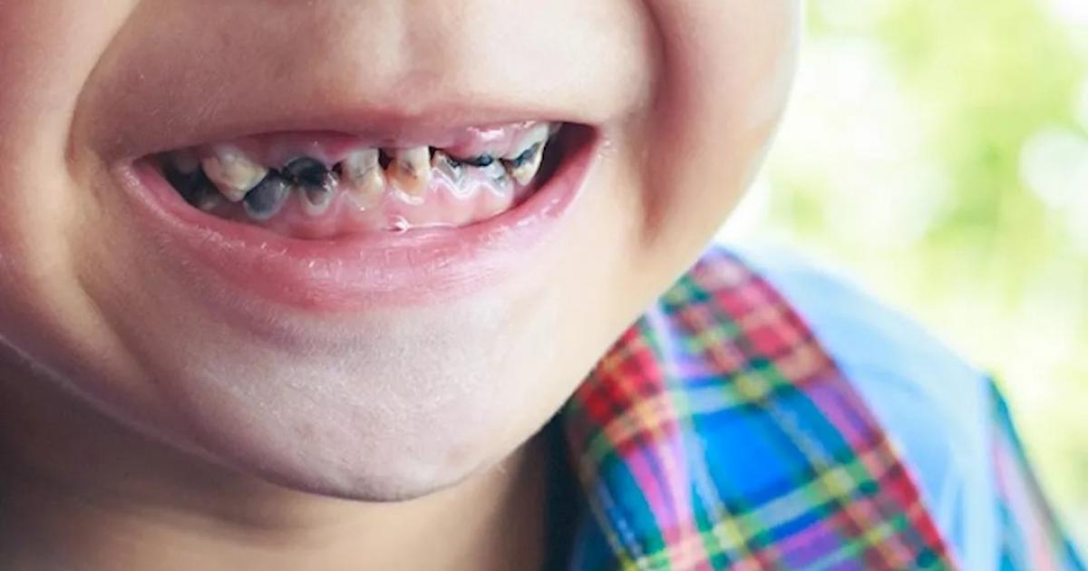 ما هي أسباب تسوس الأسنان المبكر وهل من السهل علاجها؟