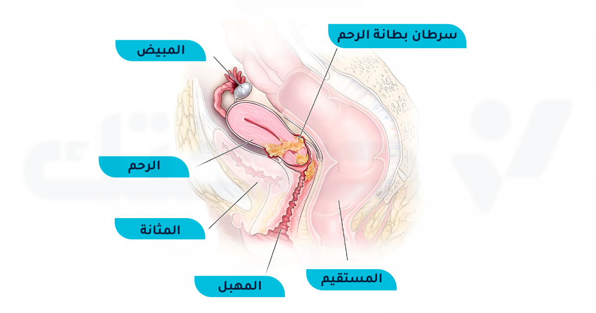 ما هي علامات سرطان بطانة الرحم وهل يمكن الشفاء منه؟