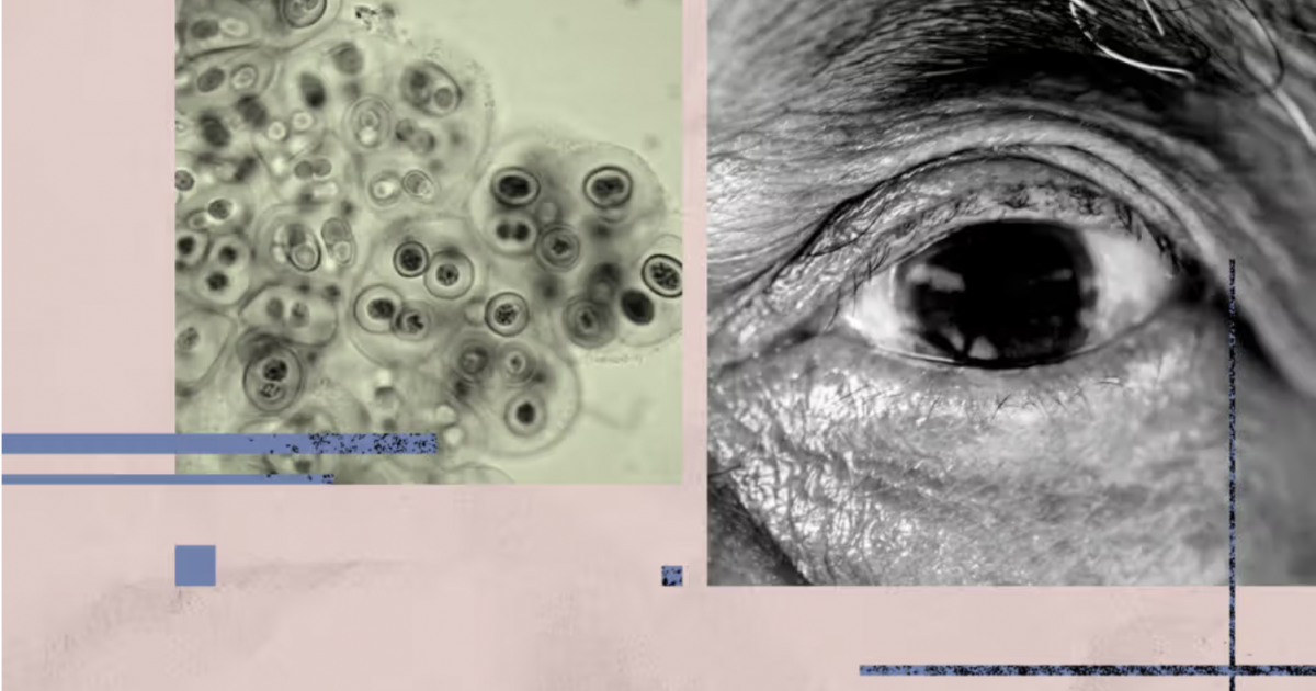 هل يمكن أن تكون بكتيريا في العين مفتاحًا خفيًا وراء مرض ألزهايمر؟