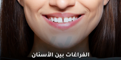 الفراغات بين الأسنان: أسبابها وعلاجها وطرق الوقاية