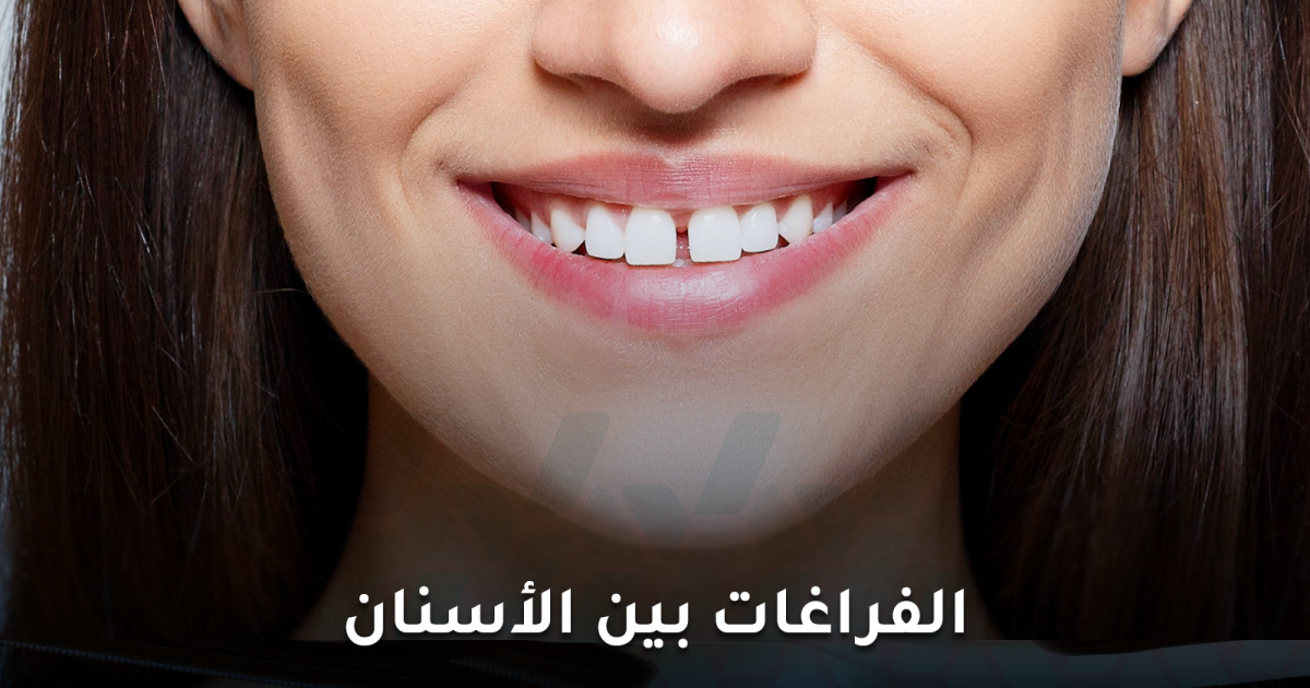 الفراغات بين الأسنان: هل هي حالة طبية بحاجة إلى علاج؟