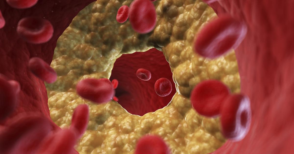 امتصاص الكوليسترول العالي قد يزيد خطر أمراض القلب
