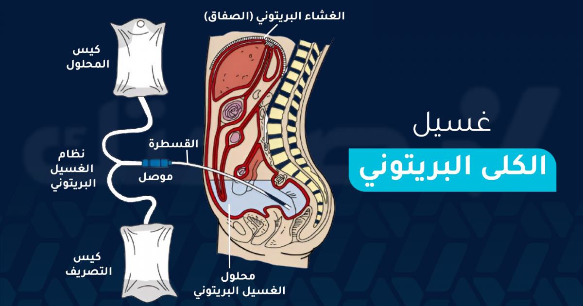 غسيل الكلى البريتوني: ما هي مميزاته وعيوبه ومتى يستخدم؟