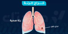 شفاء خراج الرئة: الأعراض، الأسباب، والعلاج