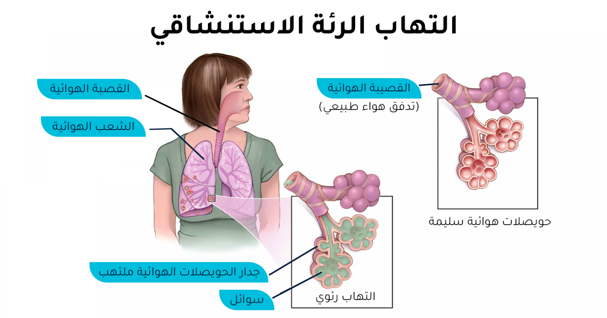هل يمكن الشفاء من التهاب الرئة الاستنشاقي وما مضاعفاته؟