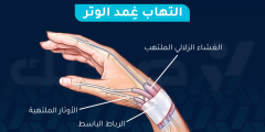 التهاب غمد الوتر: الأسباب والأعراض وطرق العلاج الفعالة