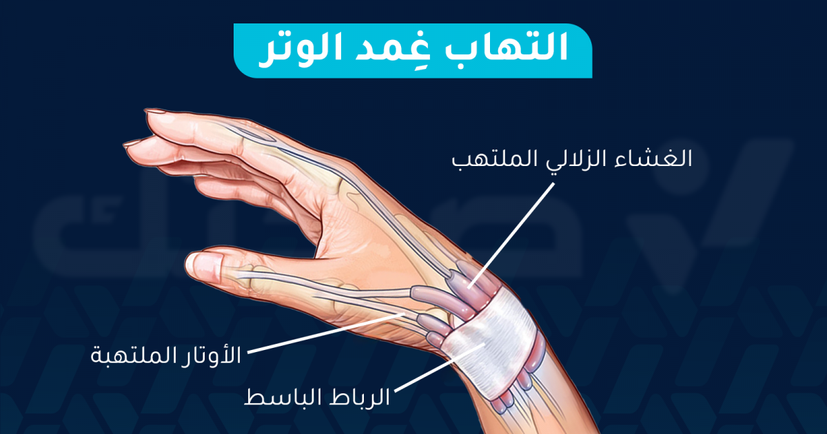 التهاب غمد الوتر: الأسباب والأعراض وطرق العلاج