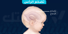 تضخم الرأس: الأسباب والأعراض وطرق العلاج
