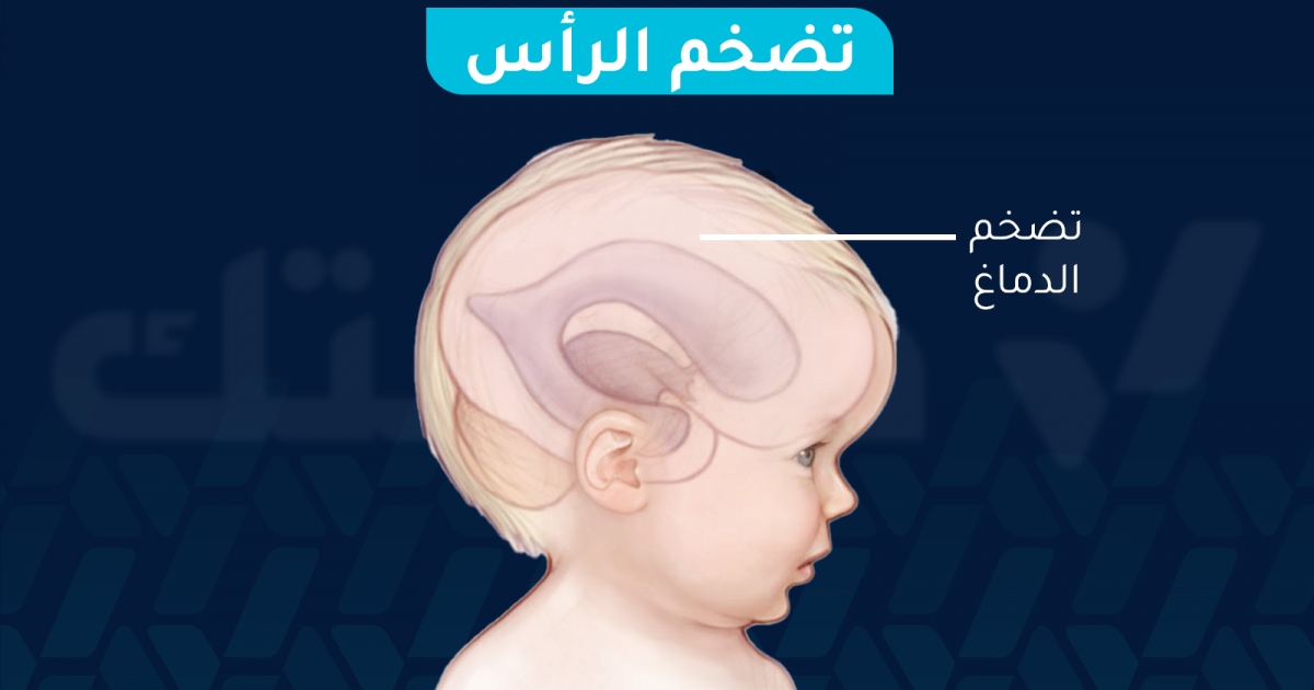 تضخم الرأس: الأسباب والأعراض وطرق العلاج