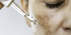 طرق فعالة لعلاج الكلف والحفاظ على النتائج