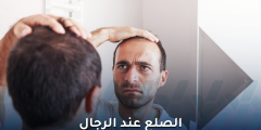 كل ما تحتاج معرفته عن الصلع عند الرجال وتأثيره