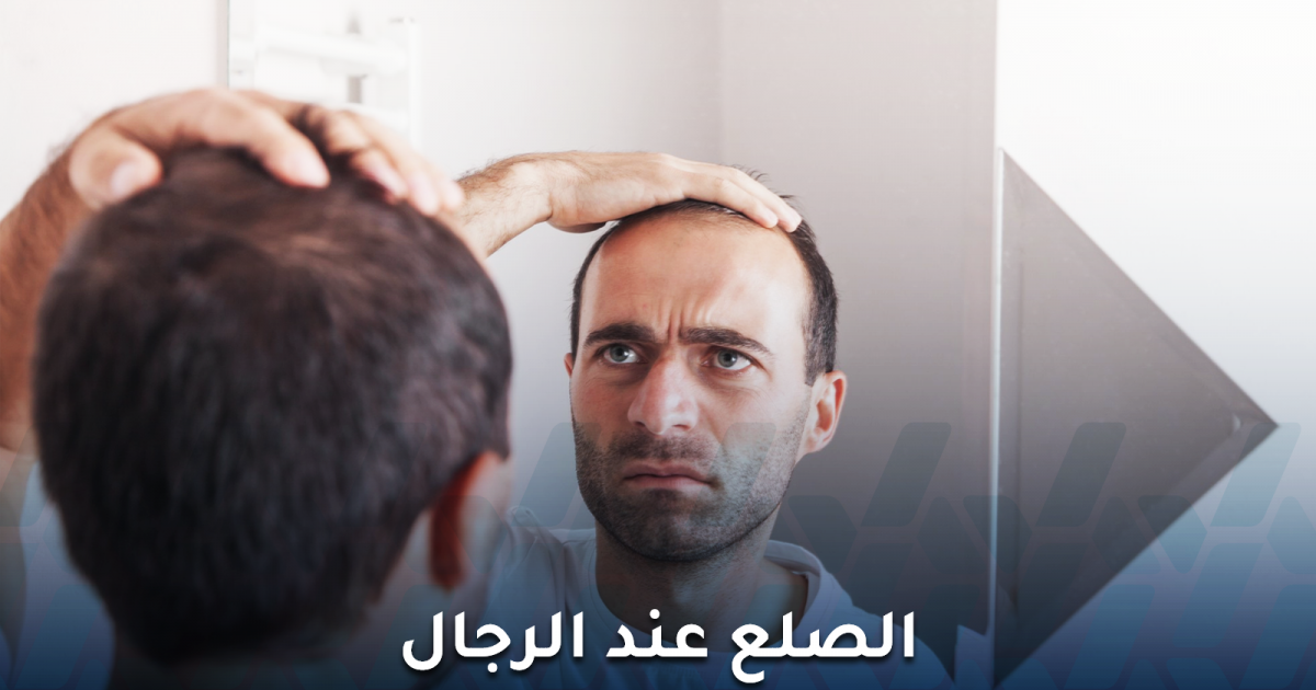 كل ما ينبغي معرفته عن الصلع عند الرجال وتأثيره عليهم