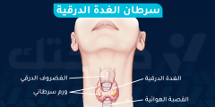 أعراض سرطان الغدة الدرقية ونسبة الشفاء منه