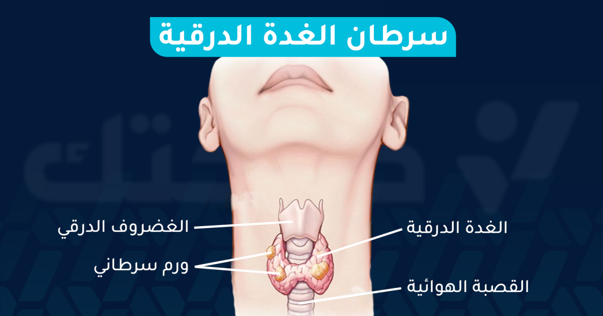 ما هي أعراض سرطان الغدة الدرقية وما نسبة الشفاء منه؟