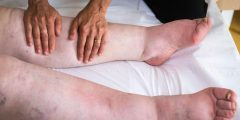 فوائد المساج الليمفاوي لمرضى الليبيديما: كيف يساعد في تخفيف الأعراض