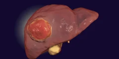 دواء FDA يعزز العلاج المناعي ضد سرطان الكبد النادر
