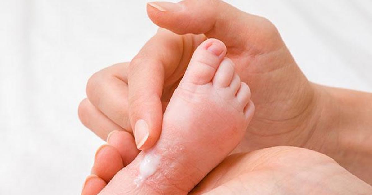هل استخدام حليب الأم لعلاج الأكزيما فعال حقاً؟