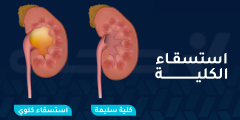 استسقاء الكلية: الأعراض، الأسباب، العلاج والمضاعفات