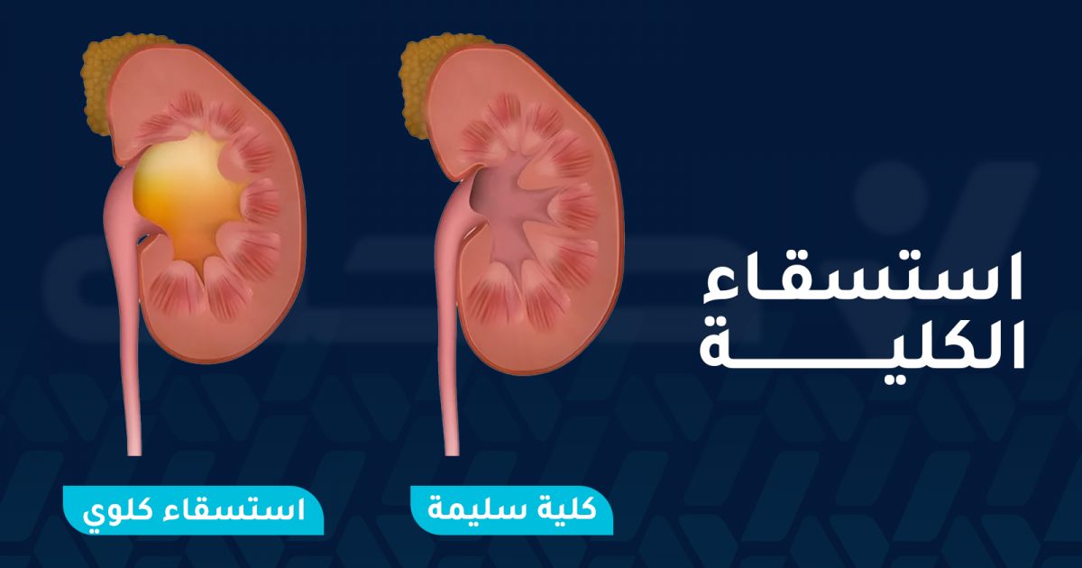 هل استسقاء الكلية خطير؟ وكيف يتم علاجه وما الأعراض والأسباب؟