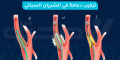 تركيب دعامة الشريان السباتي: الوقاية من السكتات الدماغية