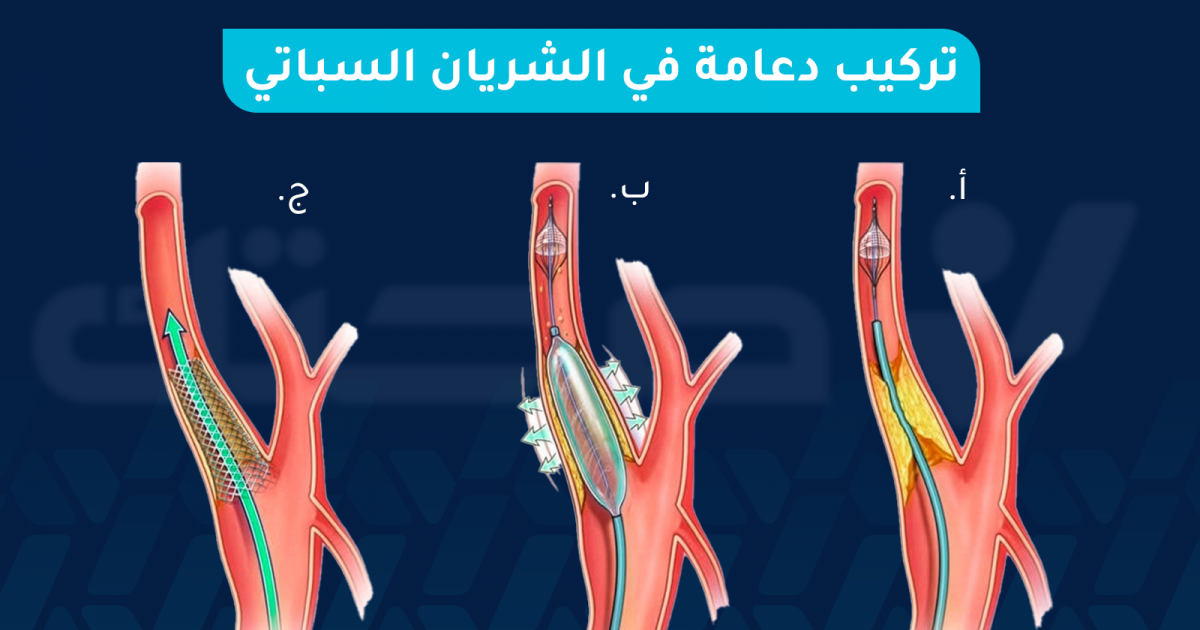 تركيب دعامة الشريان السباتي يقلل خطر الإصابة بالسكتة الدماغية