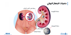 أسباب زيادة حصى الكلى في الصيف وطرق الوقاية